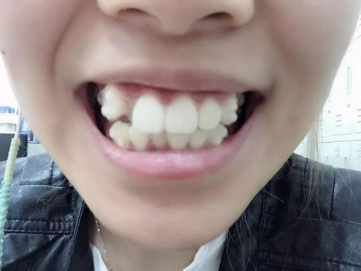 正雅隐形牙套效果怎么样（正雅隐形牙套方案要等多久）(图1)